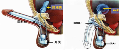 邢台最好的男科医院--阴茎起搏器