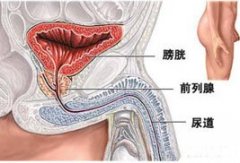 前列腺囊肿有几种类型