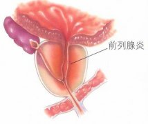 邢台现代医院专家教你冬季预防前列腺炎