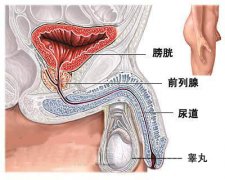 生活中男性前列腺炎应该注意哪些