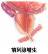 剖析前列腺增生的常见危害