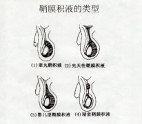 　盘点男性鞘膜积液的4种类型