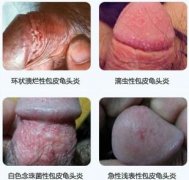 龟头上有红斑是什么原因?