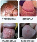 什么因素导致包皮龟头炎的?