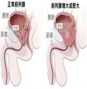 前列腺增生的初期表现
