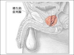 前列腺增生会损害肾脏功能吗?