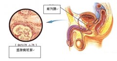 如何判断前列腺炎是否治疗?