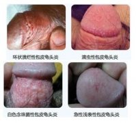 龟头发肿瘙痒是咋回事?