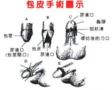 包皮过长的危害有多大，哪种手术治疗好?